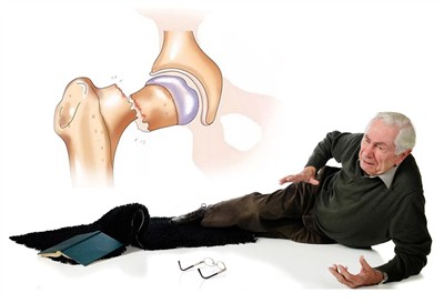 Miért vezetnek a mindennapi viselkedés gyakori törésekhez az idősebb felnőtte...